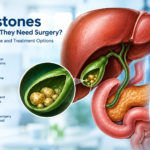 Gallstones in the gallbladder shown in a medical illustration with the liver and digestive system, highlighting symptoms, stone size, treatment options, and when surgery may be needed